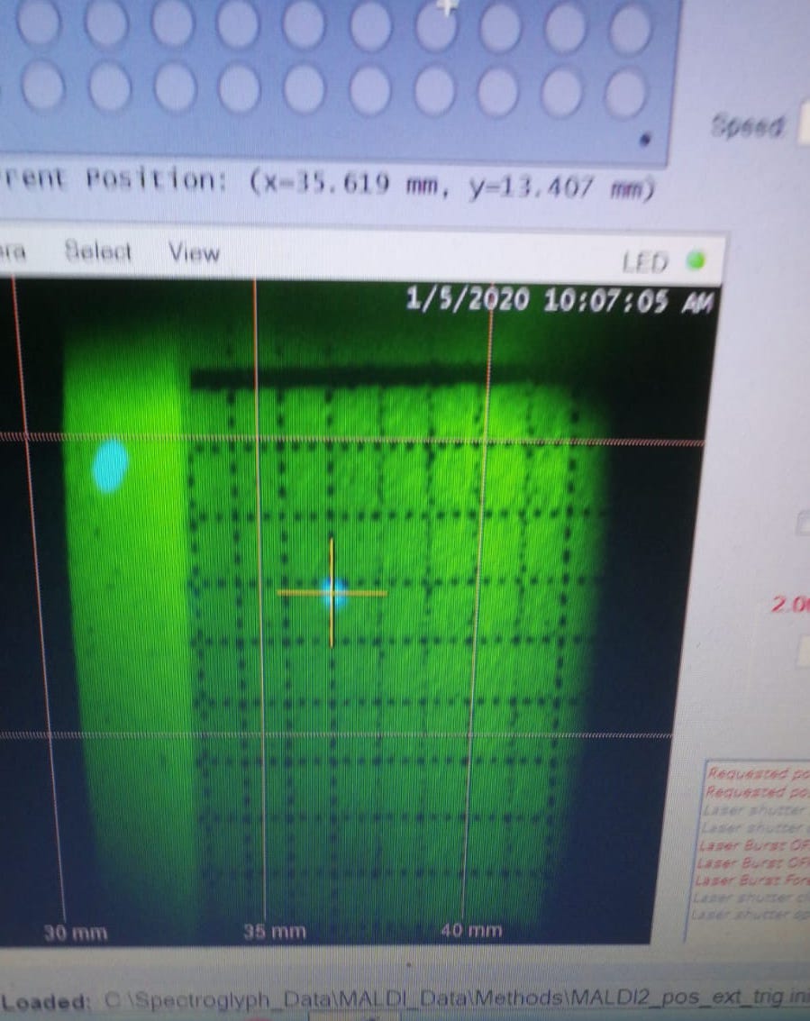 An example of Crylas laser shift. The two lasers are not alighed.